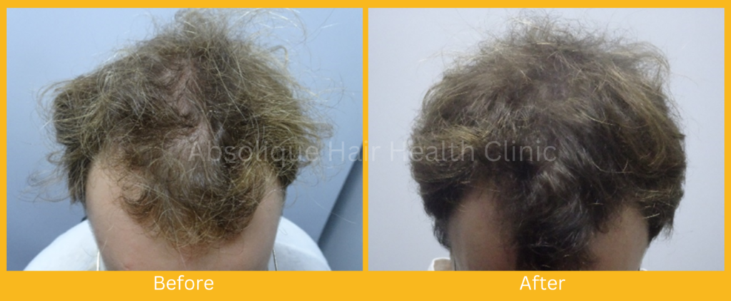 Male Balding Treatment
