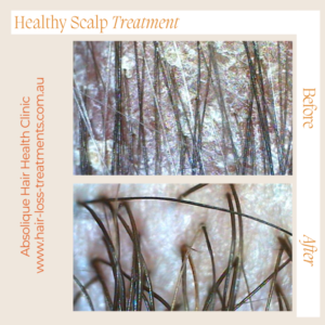 Eating for scalp treatment