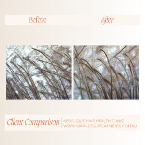 Scalp Treatment Brisbane