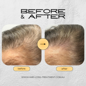 Best Hair Loss Treatment for Women