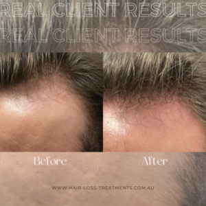 Hair loss treatments mens health