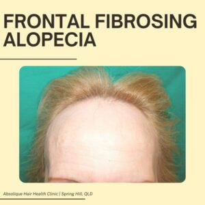 Frontal fibrosing alopecia