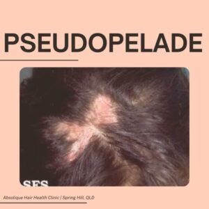 Pseudopelade
