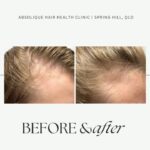 Low Ferritin Hair Loss Female
