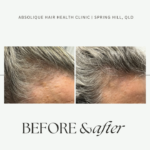Women's hair regrowth and curl transformation