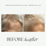 Let's talk about women's hair loss, and how to prevent it