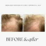 Male Baldness can impact self-esteem