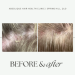 Scalp Treatment Solution - When It's More Than Dandruff