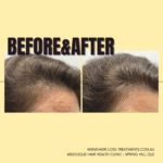 Menopause Hair Loss - Causes and Treatments