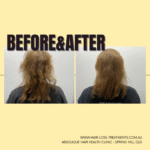 Hair Transformation - Women's Hair Loss Treatment