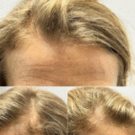 Female Hair Loss Treatment Before