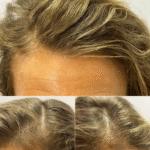 Female Hair Loss Treatment After