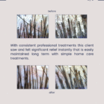Scalp Treatment Brisbane - Neurodermatitis