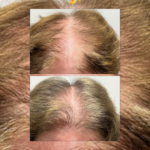 Female Pattern Hair Thinning Common Misdiagnosis