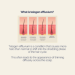 Men’s Hair Loss Story – Telogen Effluvium